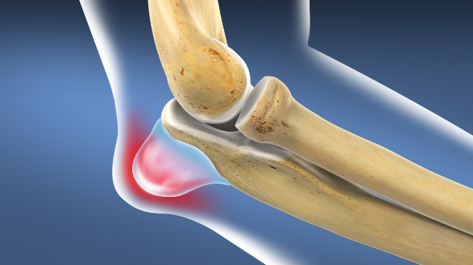 Olecranon Bursitis in Famous Athletes