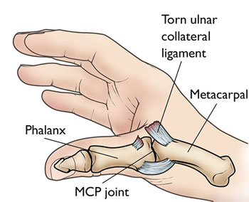 What Famous Athlete Had the Injury Gamekeeper Thumb Injury